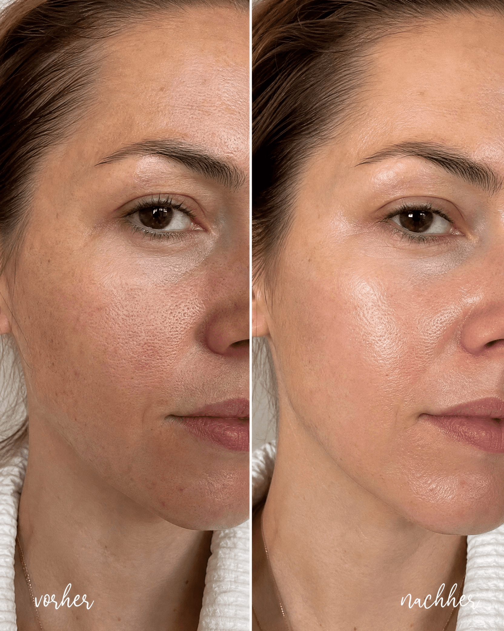 Müde, fahle Haut → Frischer Glow — Aquafacial Heilbronn C&C Beauty